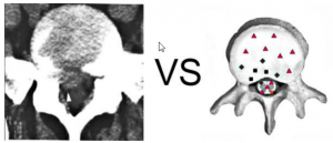 Patient S., 68 year old: Osteoplastic metastases in prostate carcinoma bone