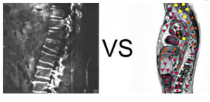 Patient N., 24 years old: Body compression fracture of the first lumbar vertebra