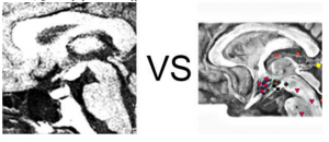 Patient V., aged 37: Lymphoma of the hypothalamus