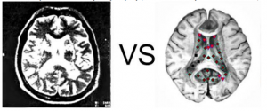 Patient Z., 54 years old: Circulatory encephalopathy (chronic insufficiency of cerebral circulation)