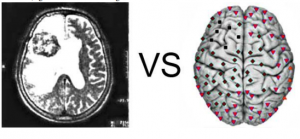 Patient S., aged 56: Metastasis of lung cancer in the left frontal lobe