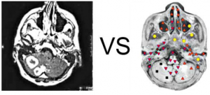 Patient Z., 62 years old: Metastases of adenocarcinoma of the kidney in the right hemisphere of the cerebellum