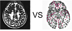 Patient P., aged 47: Typical supratentorial foci in multiple sclerosis