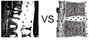 E. The patient, 54 years old. Osteochondritis of the lumbar spine