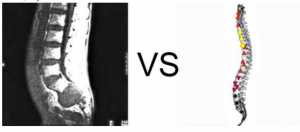 Patient, 67 years old: Fibro sarcoma sacrum