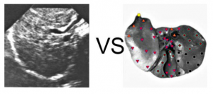 Patient G., 44 years old: Cirrhosis