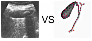 Patient P. aged 36:The gall bladder contains a single large concretion