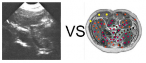 Patient S., 84 years old: Atrophy of the tail of the pancreas