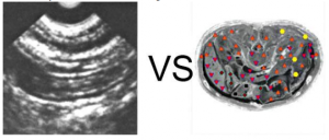 E. The patient, 42 years old. Longitudinal section: multiple cysts kidney