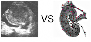 Patient S., aged 56. Longitudinal section: right kidney stone