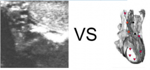 Patient T., aged 46. Longitudinal section: a large tumor (cancer) of the cervix